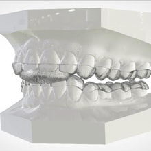 digital dental splints various 3shape tooth denture orthodontics cad 3d printing keyshot dentist 3d print model - Mito3D