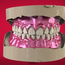 dijital tam 3d baskı freze enjeksiyon protezler çeşitli diş tıbbi cad cam rami 3shape keyshot 3d print model - Mito3D