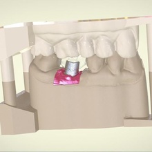 digital implant model positioning guide verschiedene dental cad 3d-drucken 3d-real-life-rendering Zahnmedizin Implantate 3d print model - Mito3D