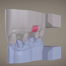 digital implant model soft tissue various dental 3d 3d printing cnc milling 3shape cad labmagic 3d cad stl obj dae medical