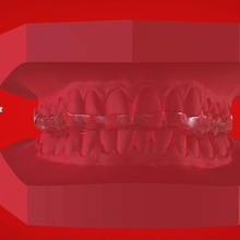 digitale michigan stecca di stampa 3d vari dental medico labmagic cad 3shape bite splint 3d print model - Mito3D