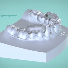 digitale mattina ri-posizionamento deprogrammer vari dental ortodonzia cad lab 3d print model - Mito3D