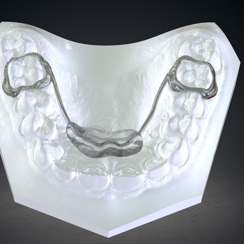 digital nance holder appliance various orthodontic 3D print model - Mito3D