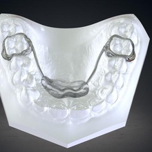 digital nance holder appliance various orthodontic 3d print model - Mito3D