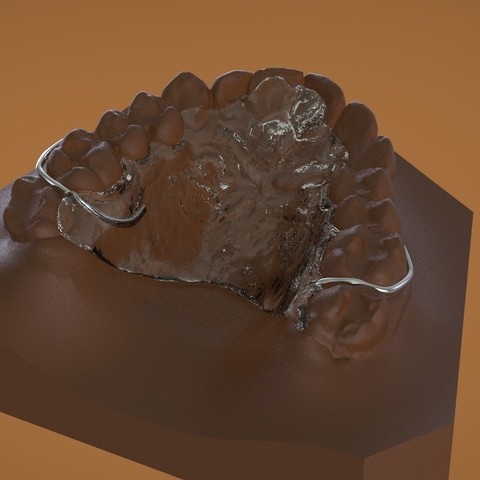 digital ortho dti deprogrammer aparelho vários ortodontia dental o cad A impressão 3d fabricação de aditivos laser sintering 3D print model - Mito3D