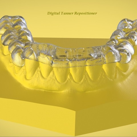 digital ortho tanner repositioner tala vários médica dental ortodontia medicina do sono Impressora 3d A digitalização cad 3D print model - Mito3D