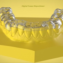 digital ortho tanner repositioner splint various medical dental orthodontics sleep medicine 3d printer scanning cad 3d print model - Mito3D