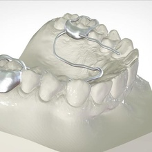 digital-porter-appliance verschiedene 3d-drucken die medizinische Kunst kieferorthopädische dental 3d print model - Mito3D