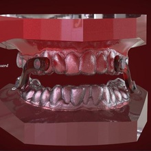 digitale Schlafapnoe mouthguard various medicine labmagic 3d cad medical dental 3shape appliance splint rmi orthodontics keyshot denture 3d print model - Mito3D