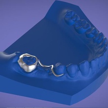 o espaço digital mantenedor vários dental 3d ortodontia laboratório de prótese dentária 3shape keyshot 3d print model - Mito3D