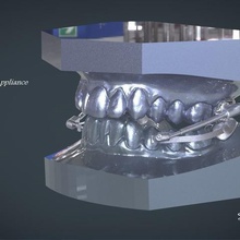 digital telescópica aparato de herbst varios dental 3d la ortodoncia cd odontología diente dientes médica aparatos funcionales keyshot 3shape rami labmagic cad en obj stl 3d print model - Mito3D