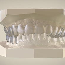 digitale zahn-Positionierer verschiedene dental cad 3d Kieferorthopädie 3d print model - Mito3D