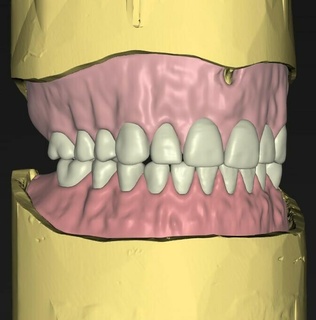 dijital Toplam protezler diş doktoru 3d print model - Mito3D