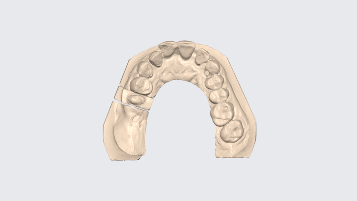 muñecas 7 dental protésico técnico diente modelo exocad 3d stl dentista gratis ortodoncia odontología impresión canalla tocón albardilla 3d print model - Mito3D