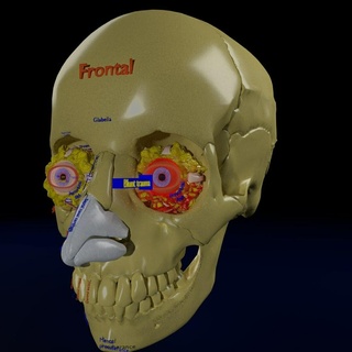 eye blow model orbit injury fracture maxilla face fist trauma orbital eyeball vision skull labelled 3d print model - Mito3D