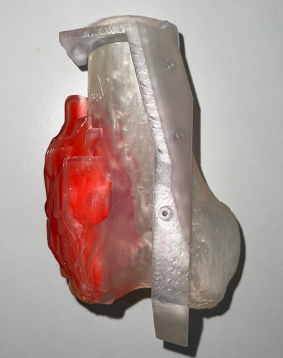femoral osteosarkom femur sarkom tumor krebs kondylus chirurgisch leiten anatomie 3d print model - Mito3D