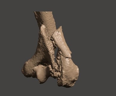 fractura distal final húmero trauma traumatología ortopedía humeral hombro osteosíntesis 3d print model - Mito3D