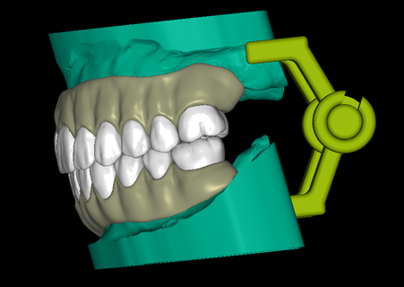 full denture model upper lower dental teeth dentist articulator arch jaw models 3d print model - Mito3D