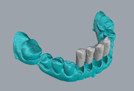 geller dental modelo chapa práctica 3d print model - Mito3D