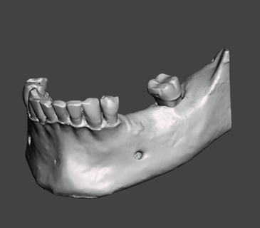 guiado implantar cirurgia modelos implantes dentista mandíbula dentes cbct 3d print model - Mito3D