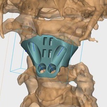 individuel implant cage patient c2 tumeur réel opération gadget médicament chirurgie docteur colonne vertébrale imprimé salut titane ti6al4v prothétique bio ingénieur pn 3d print model - Mito3D