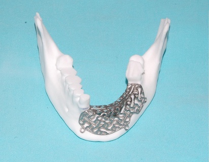 individuale maglia membrana osso ricostruzione mascella esempi vero operazioni mandibola medicinale chirurgia medico 3d stampato Ciao titanio ti6al4v impiantare protesi bioingegnere pn 3d print model - Mito3D