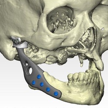 individuale protesi mascella ricostruzione vero operazione medicinale condilare coppia craniale mandibola chirurgia 3d Ciao titanio ti6al4v chirurgico polietilene impiantare protesica bioingegnere pn 3d print model - Mito3D