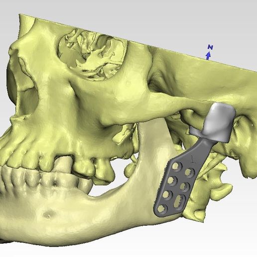 Individuell tmj Prothese Real Operation Medizin Kondylen Schädel implantieren Titan 3d Hallo pn 3D print model - Mito3D