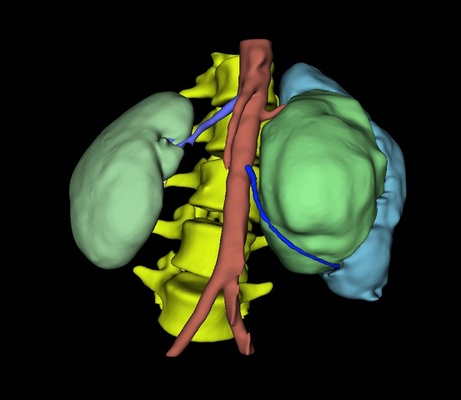 rene cisti anatomia tumore medico medicinale 3d print model - Mito3D