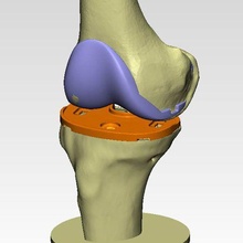 ginocchio comune protesi guide campione individuale attrezzo medicinale operazione chirurgia tibiale femorale 3d Ciao sla stampato pn 3d print model - Mito3D