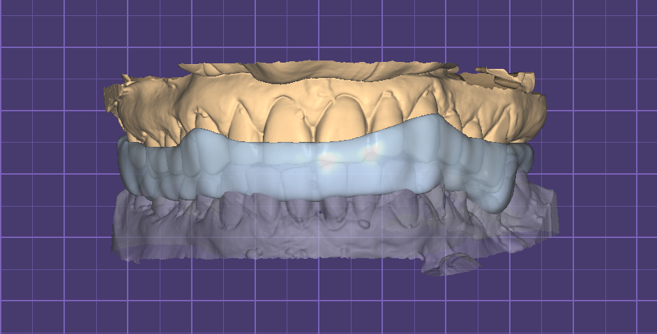 Michigan difícil descarga entablillar + modelos dental modelo férulas diente dentista prótesis 3D print model - Mito3D