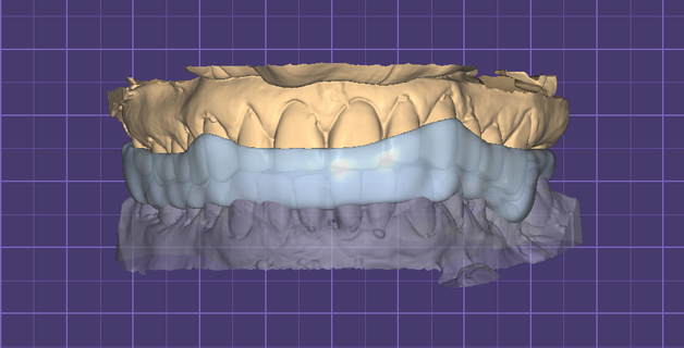 michigan hard discharge splint + models dental model splints tooth dentist prosthesis 3d print model - Mito3D