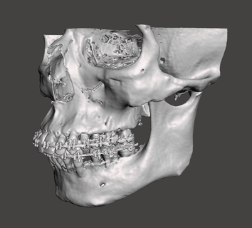 medio tercero mandíbula biomodelo 3d print model - Mito3D