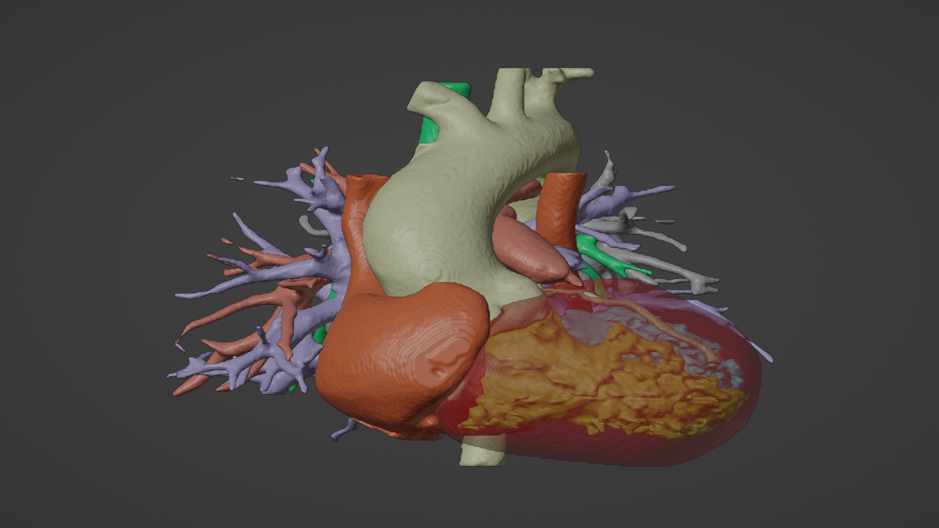 model insan kalp pulmoner atrezi pua oluşturulmuş gerçek hasta kardiyovasküler sistemi Odalar 3d kardiyoloji doğuştan hastalık 3D print model - Mito3D