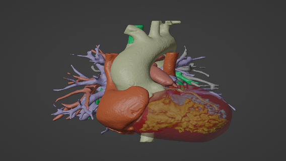 model human heart pulmonary atresia pua - generated real patient cardiovascular cardiac system chambers 3d cardiology congential disease 3d print model - Mito3D