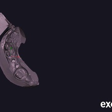 modello scansione vs impressione impiantare protesi 3d print model - Mito3D