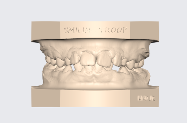 modelo dentale superiore inferiore articulado 10 protesico t cnico dente modello exocad 3d stl dentista gratuito gratis ortodonzia impresi n 3d print model - Mito3D