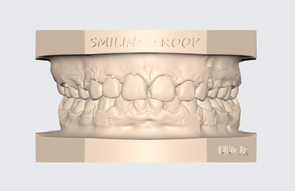 modelo dental überlegen niedriger articulado 11 prothetisch cnico zahn modell exocad 3d stl dentista frei gratis kieferorthopädie impresi 3D print model - Mito3D