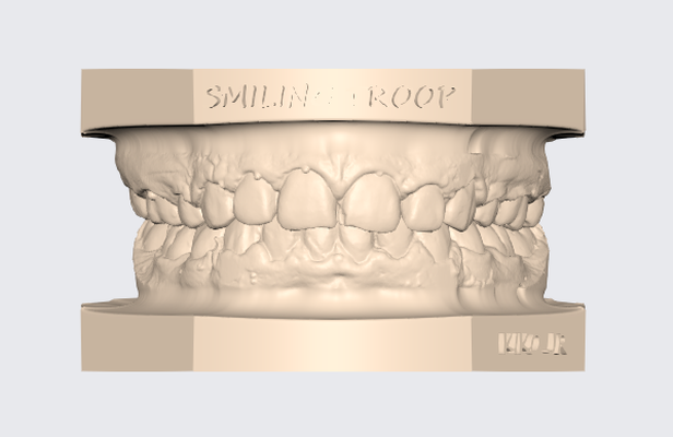 modelo dentaire supérieur inférieur articulado 11 prothétique cnico dent modèle exocad 3d stl dentiste libre gratuitement orthodontie impresi 3d print model - Mito3D
