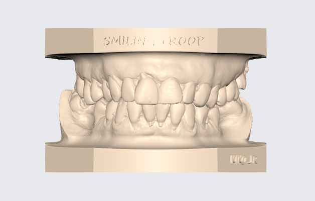modelo dentale superiore inferiore articulado 12 protesico t cnico dente modello exocad 3d stl dentista gratuito gratis ortodonzia impresi n 3d print model - Mito3D