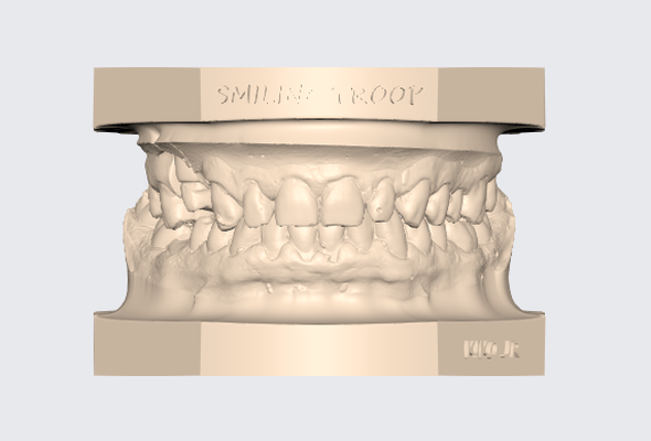 modelo dentale superiore inferiore articulado 13 protesico t cnico dente modello exocad 3d stl dentista gratuito gratis ortodonzia impresi n 3d print model - Mito3D