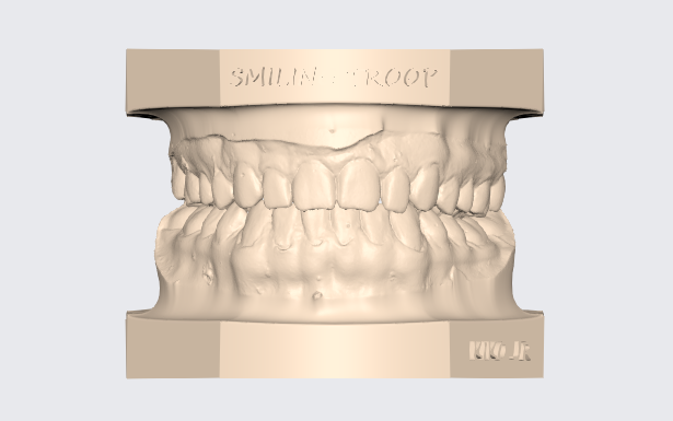 modelo dentaire supérieur inférieur articulado 14 prothétique cnico dent modèle exocad 3d stl dentiste libre gratuitement orthodontie impresi 3D print model - Mito3D
