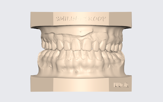 modelo dentale superiore inferiore articulado 14 protesico t cnico dente modello exocad 3d stl dentista gratuito gratis ortodonzia impresi n 3d print model - Mito3D