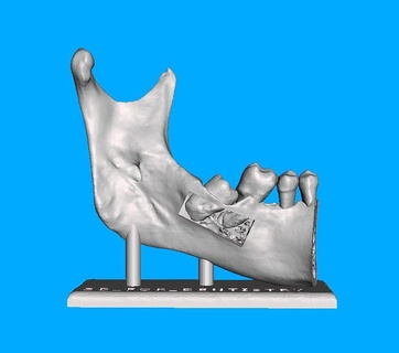 modelo terceiro molar teeth meshmixer 3d print model - Mito3D
