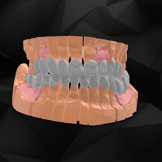 boca restauração ferramenta 3dmodel dental dentista odontologia dentadura humano modelo dentes dente mandíbula implantes 3D print model - Mito3D
