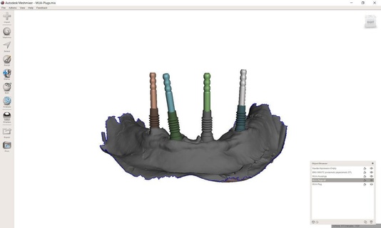 multiunit abutment plug dental implants biology education science 3d print model - Mito3D