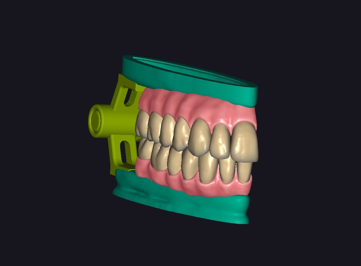 occlusion dents contact points dentaire dent articulateur 3D print model - Mito3D