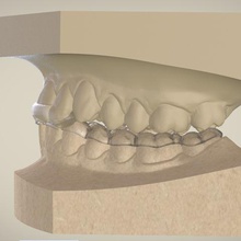 ortho-superior-repositioner schiene verschiedene dental 3d 3d-drucken die Kieferorthopädie cad 3shape keyshot Modell 3d print model - Mito3D