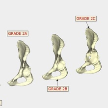 paprosky Einstufung Hüftpfanne Knochen Verlust 3d print model - Mito3D