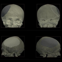 piatto cranioplasty vero operazione attrezzo craniale medicinale chirurgia 3d stl Ciao coppia pn 3d print model - Mito3D